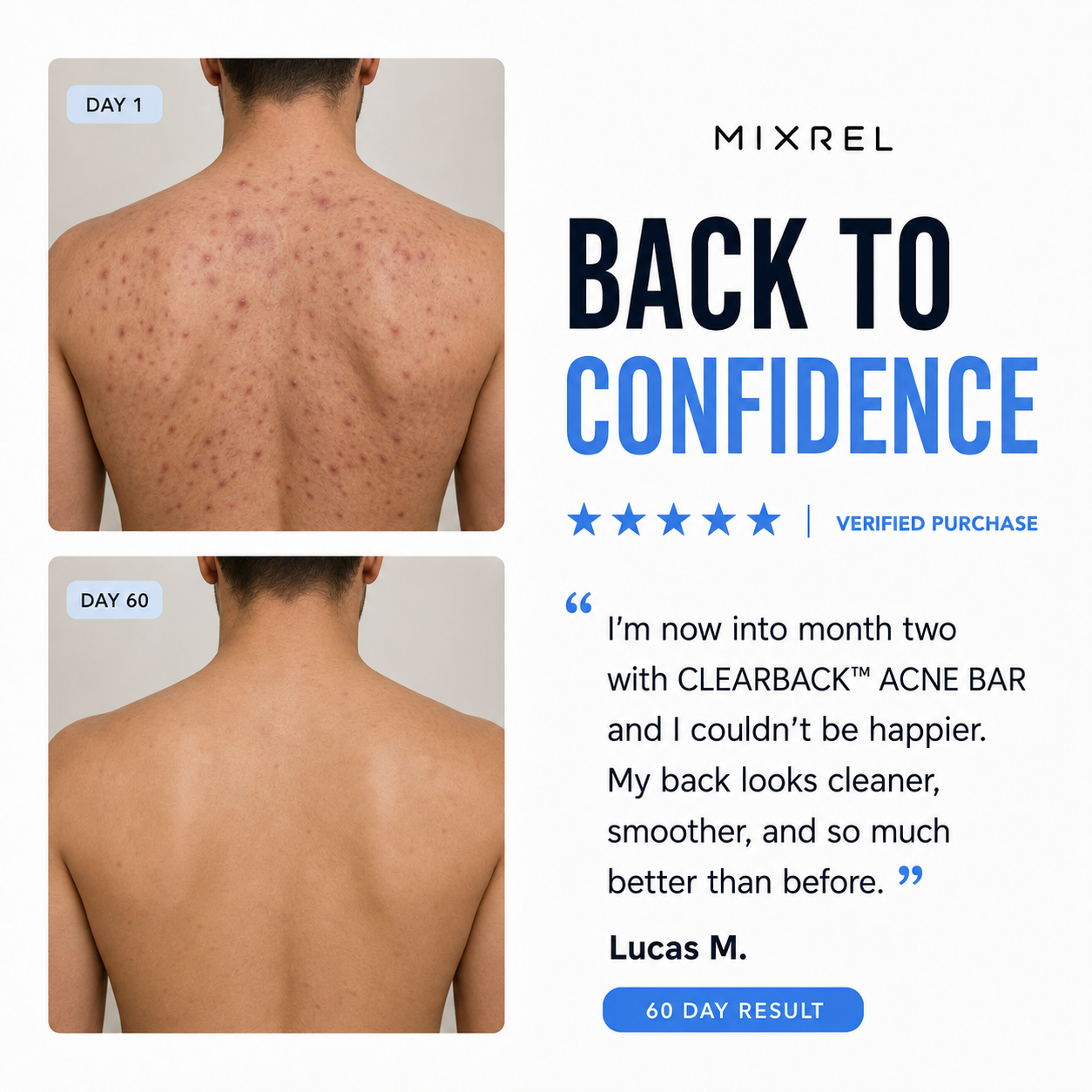 CLEARBACK™  ACNE BAR